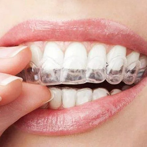 Braces: What To Expect During Treatment