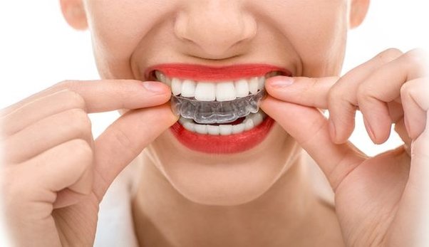 Best Practices For Caring For Your Invisalign Trays